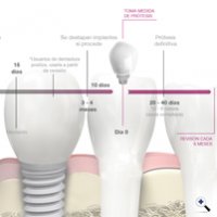 Fases del Tratamiento con Implantes